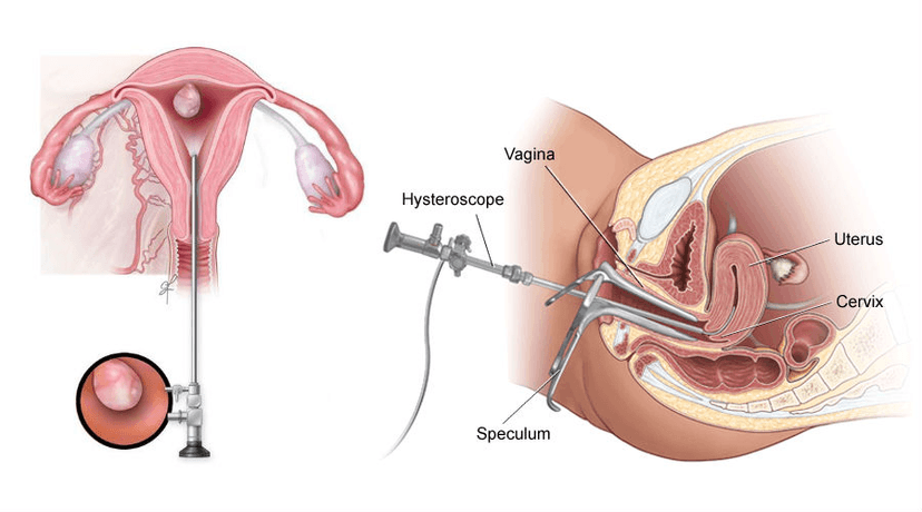 Hysteroscopy