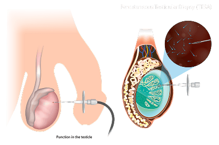 Surgical Sperm Retrieval