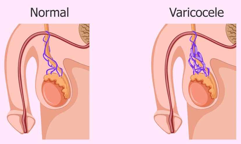 Varicocele Treatment